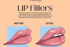 lip-fillers-before-and-after